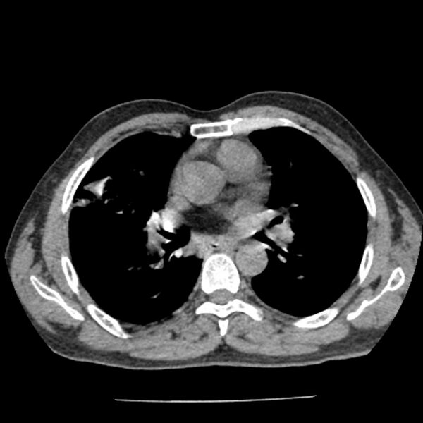 File:Airway foreign body in adult (Radiopaedia 85907-101779 Axial liver window 82).jpg