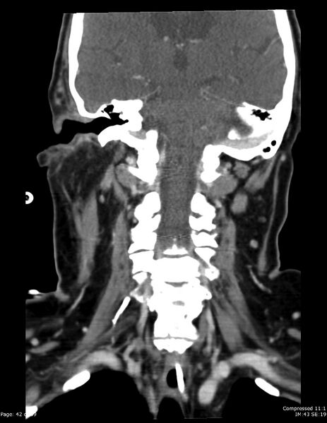 File:Airway narrowing post surgical drainage of neck abscess (Radiopaedia 28885-29206 B 33).jpg
