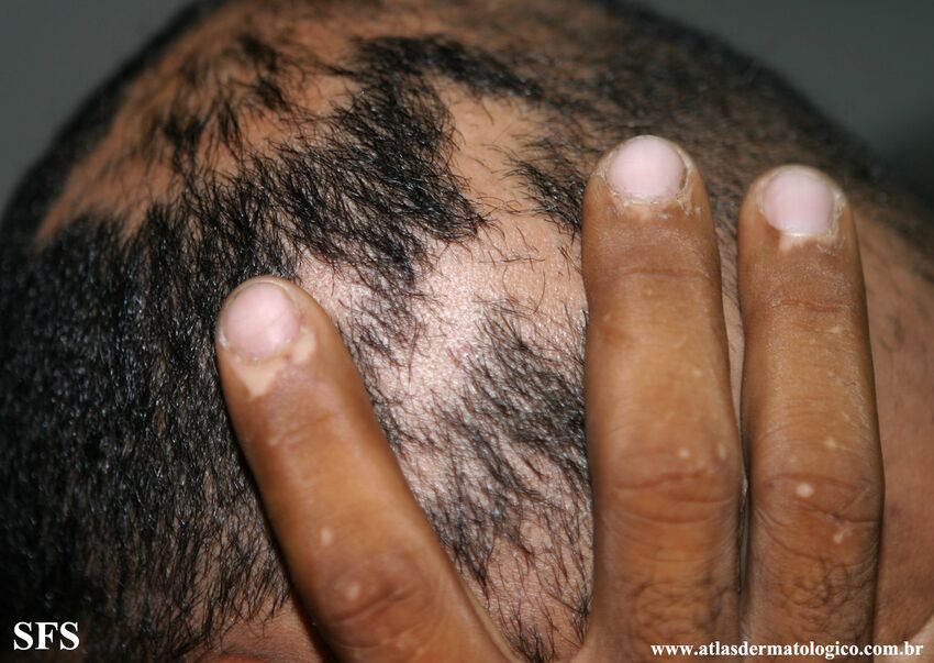 Alopecia Areata And Vitiligo (Dermatology Atlas 9).jpg