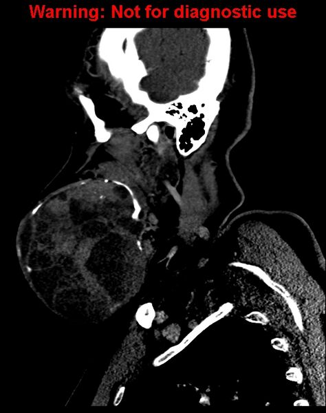 File:Ameloblastoma (Radiopaedia 33126-34164 F 16).jpg