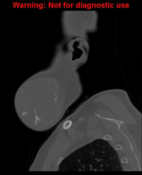 File:Ameloblastoma (Radiopaedia 33126-34164 Sagittal bone window 13).jpg