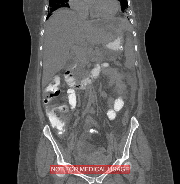 File:Amoebic enterocolitis with liver abscess (Radiopaedia 35100-36609 B 86).jpg