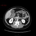 Ampullary carcinoma (Radiopaedia 56396-63056 B 39).jpg