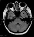 Amyotrophic lateral sclerosis (Radiopaedia 5373-7134 Axial FLAIR 7).jpg