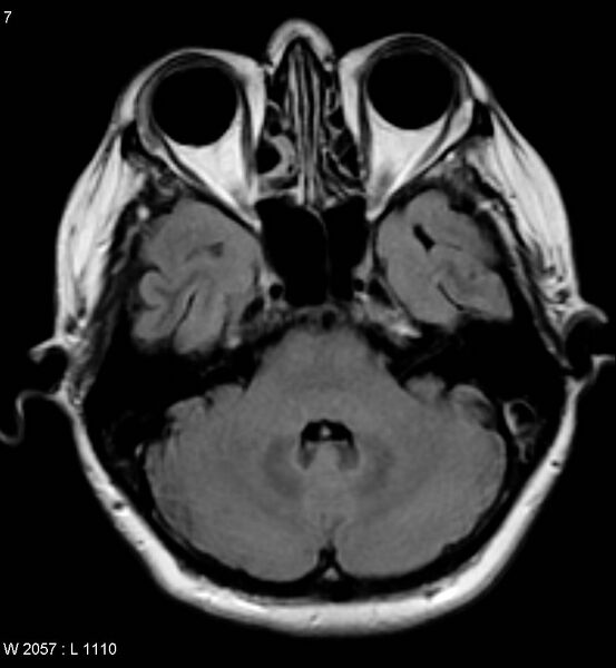 File:Amyotrophic lateral sclerosis (Radiopaedia 5373-7134 Axial FLAIR 7).jpg