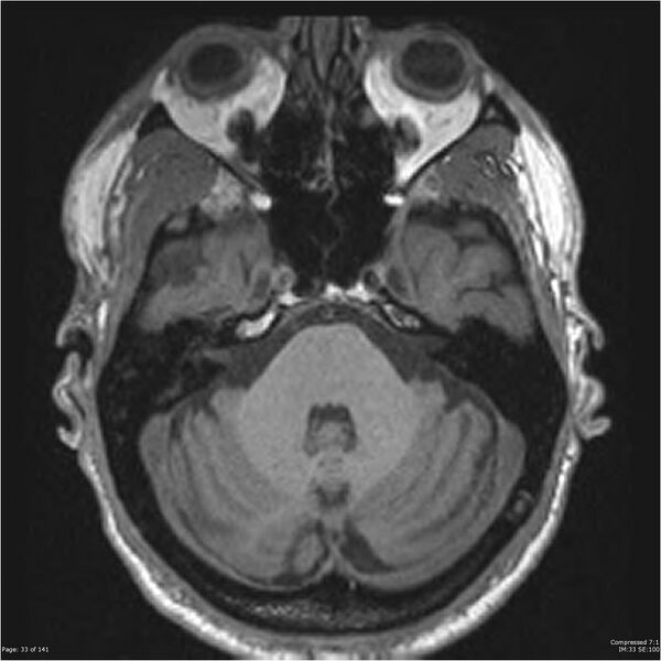 File:Anaplastic meningioma with recurrence (Radiopaedia 34452-35788 Axial T1 31).jpg