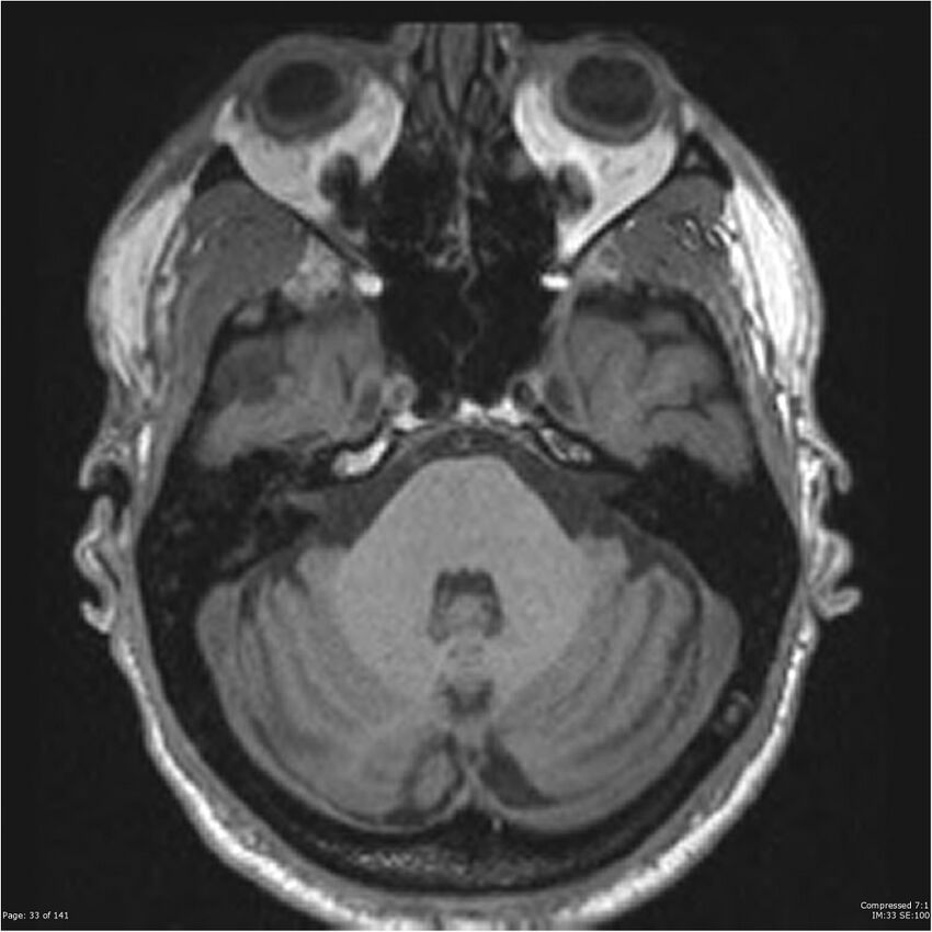 Anaplastic meningioma with recurrence (Radiopaedia 34452-35788 Axial T1 31).jpg