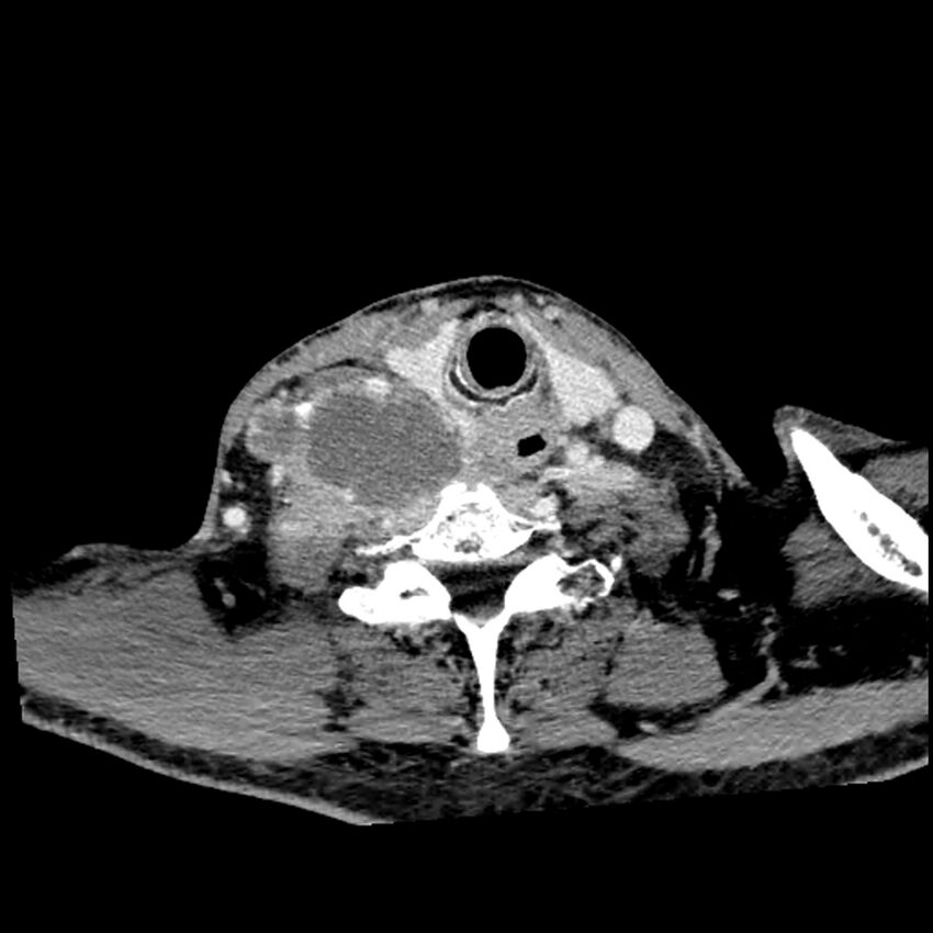 Anaplastic thyroid carcinoma (Radiopaedia 79087-92034 B 46).jpg