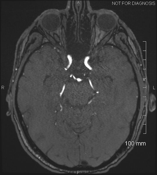 File:Anterior cerebral artery aneurysm (Radiopaedia 80683-94127 Axial MRA 90).jpg