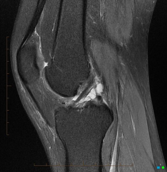 File:Anterior cruciate ligament ganglion cyst (Radiopaedia 3582-6491 Sagittal PD fat sat 1).jpg