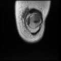 Anterior cruciate ligament tear, Wrisberg rip and bucket-handle tear of medial meniscus (Radiopaedia 75872-87266 Coronal T1 4).jpg