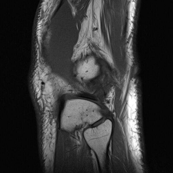 File:Anterior cruciate ligament tear - ramp lesion (Radiopaedia 71883-82322 Sagittal T1 4).jpg