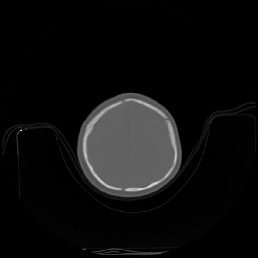 Anterior plagiocephaly (Radiopaedia 71836-82273 C 86).jpg