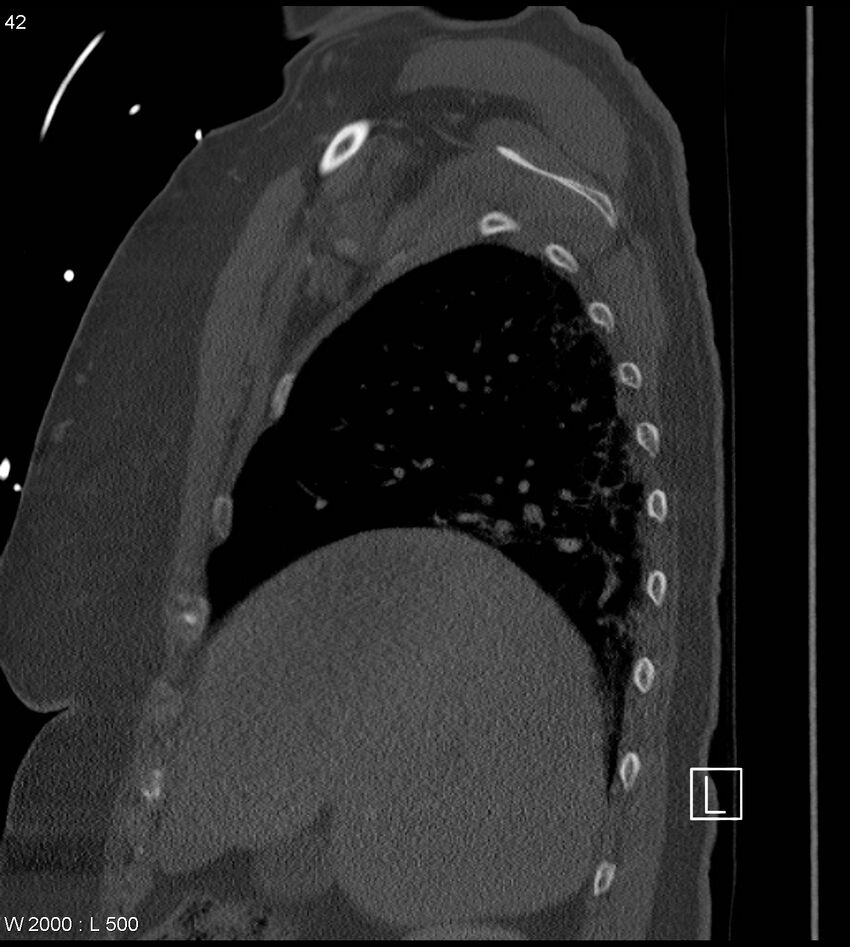 Anterior shoulder dislocation (CT) (Radiopaedia 59032-66309 Sagittal bone window 21).jpg