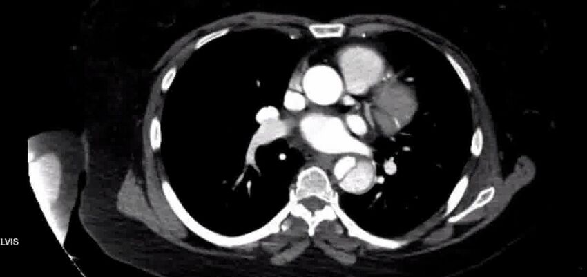 Aortic Dissection (Radiopaedia 85272-100847 A 24).jpg
