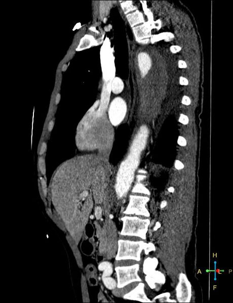 File:Aortic aneurysm and penetrating ulcer (Radiopaedia 23590-23704 C 26).jpg