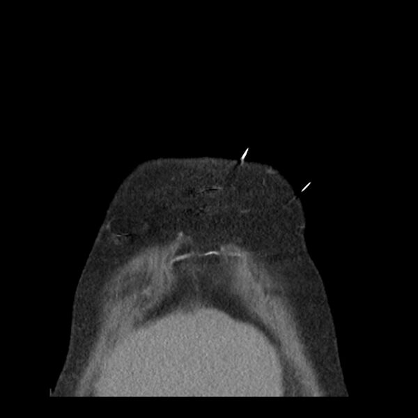 File:Aortic arch graft infection (FDG PET-CT) (Radiopaedia 71975-82437 Coronal 6).jpg