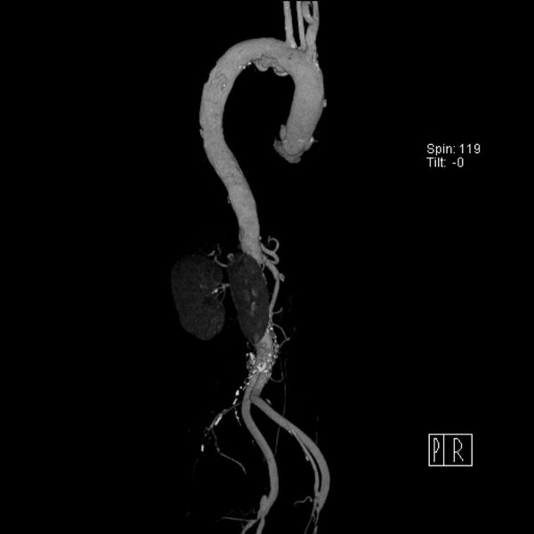 File:Aortic arch saccular aneurysm (Radiopaedia 19430-19457 A 13).jpg