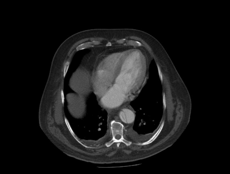 File:Aortic dissection (Radiopaedia 28802-29105 A 29).jpg