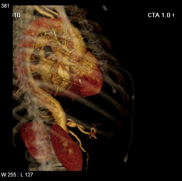 File:Aortic dissection with rupture into pericardium (Radiopaedia 12384-12647 C+ arterial phase 13).jpg