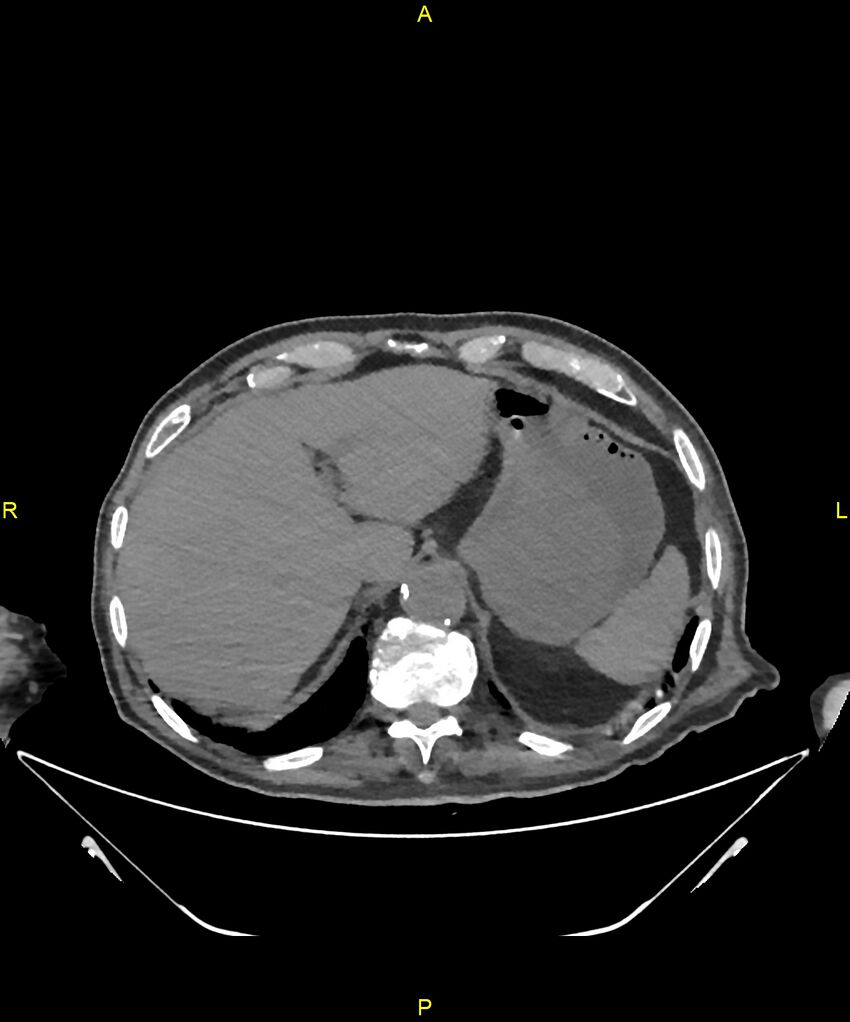 Aortoenteric fistula (Radiopaedia 84308-99603 Axial non-contrast 47).jpg