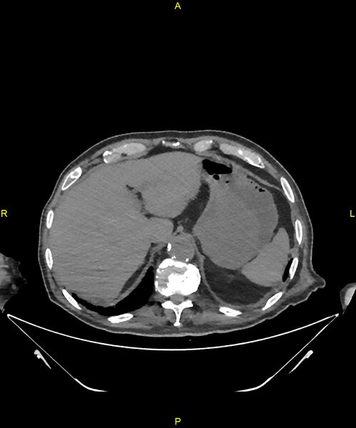 File:Aortoenteric fistula (Radiopaedia 84308-99603 Axial non-contrast 49).jpg
