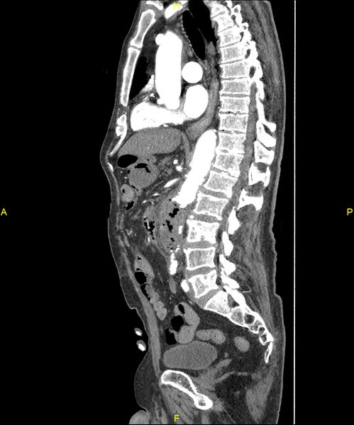 File:Aortoenteric fistula (Radiopaedia 84308-99603 C 180).jpg