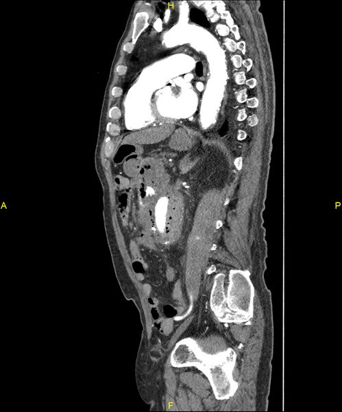 File:Aortoenteric fistula (Radiopaedia 84308-99603 C 210).jpg