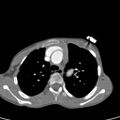 Aortopulmonary window, interrupted aortic arch and large PDA giving the descending aorta (Radiopaedia 35573-37074 B 25).jpg