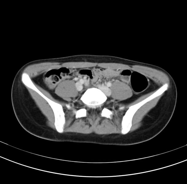 File:Appendicitis and incidental bicornuate uterus (Radiopaedia 22833-22853 B 31).jpg