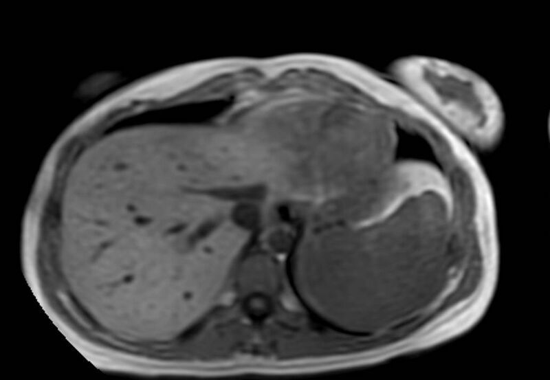 File:Appendicitis in gravida (MRI) (Radiopaedia 89433-106395 Axial T1 in-phase 4).jpg