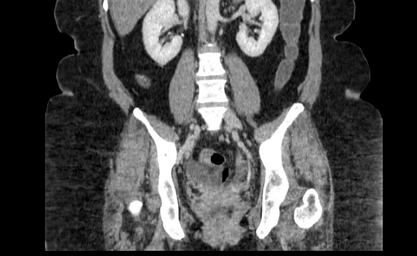 Appendix mucocele (Radiopaedia 41222-44033 B 58).jpg