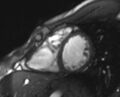 Arrhythmogenic right ventricular cardiomyopathy (Radiopaedia 69564-79464 short axis cine 115).jpg