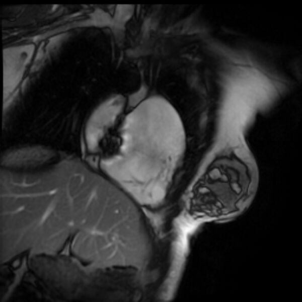 File:Arrhythmogenic right ventricular cardiomyopathy (Radiopaedia 87505-103850 2ch (RV) Cine SSFP 63).jpg
