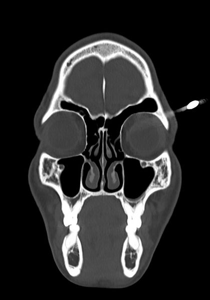 File:Arrow injury to the head (Radiopaedia 75266-86388 Coronal bone window 25).jpg