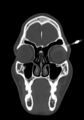 Arrow injury to the head (Radiopaedia 75266-86388 Coronal bone window 25).jpg