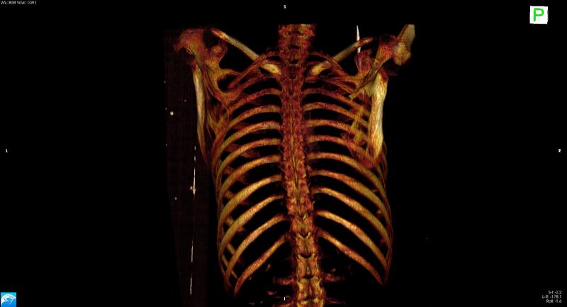 File:Arrow injury to the neck (Radiopaedia 75225-86323 3D bone 22).jpg