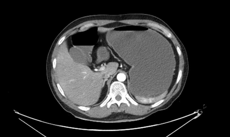 File:Arterial occlusive mesenteric ischemia (Radiopaedia 84641-100060 A 36).jpg