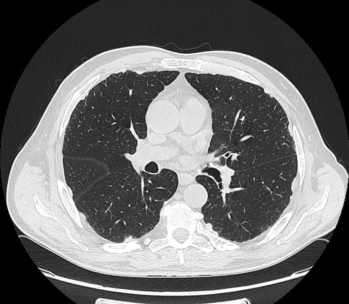File:Asbestos pleural placques (Radiopaedia 57905-64872 Axial lung window 121).jpg