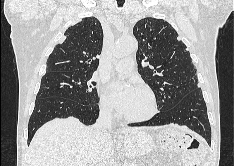 File:Asbestos pleural placques (Radiopaedia 57905-64872 Coronal lung window 122).jpg