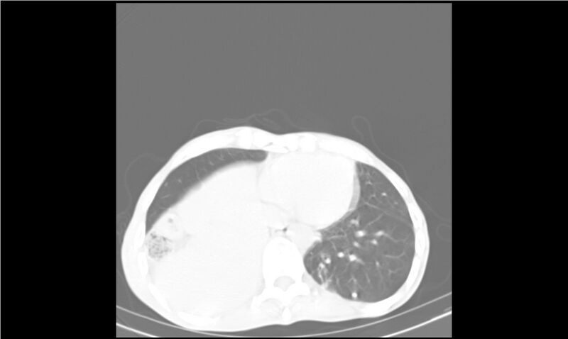 File:Aspergilloma (Radiopaedia 20788-20701 Axial lung window 28).jpg