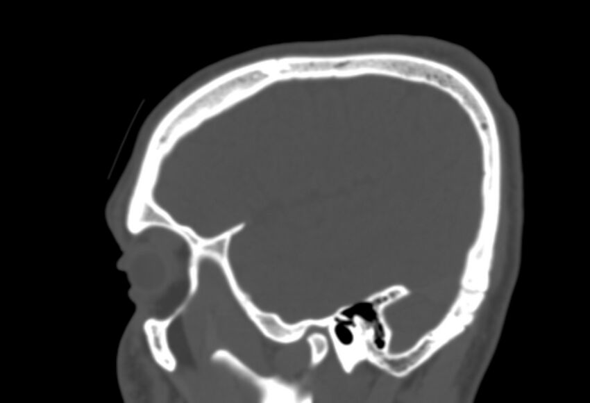 Asymptomatic occipital spur (Radiopaedia 87753-104201 Sagittal bone window 52).jpg