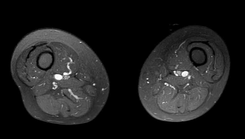 Atypical lipomatous tumor - thigh (Radiopaedia 68975-78734 Axial PD fat sat 37).jpg