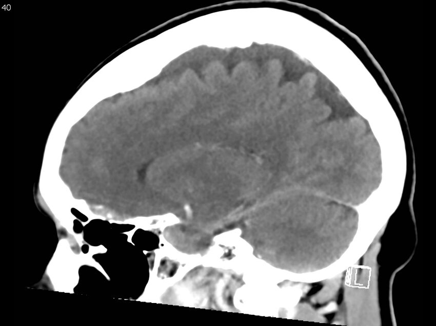 Atypical meningioma - intraosseous (Radiopaedia 64915-73867 F 39).jpg