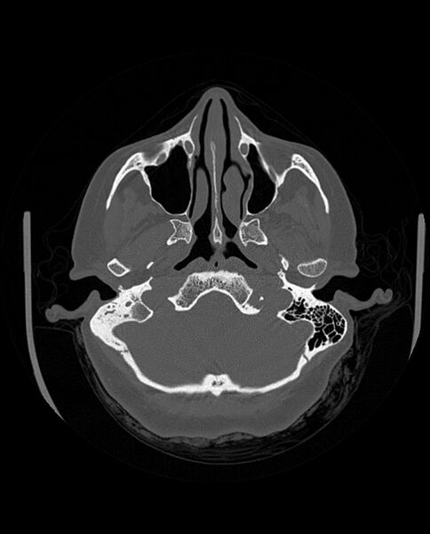 File:Automastoidectomy with labyrinthine fistula (Radiopaedia 84143-99411 Axial non-contrast 69).jpg