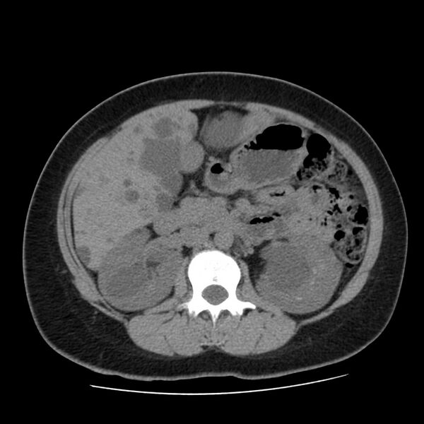File:Autosomal dominant polycystic kidney disease (Radiopaedia 23061-23093 Axial non-contrast 26).jpg