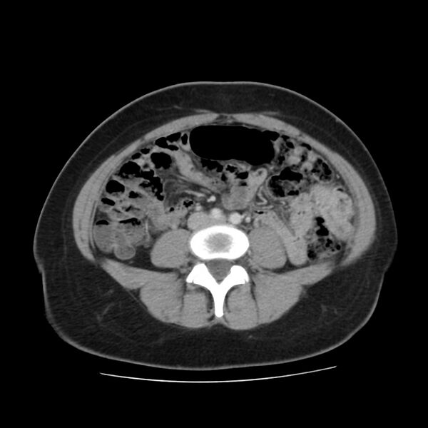 File:Autosomal dominant polycystic kidney disease (Radiopaedia 23061-23093 C 42).jpg