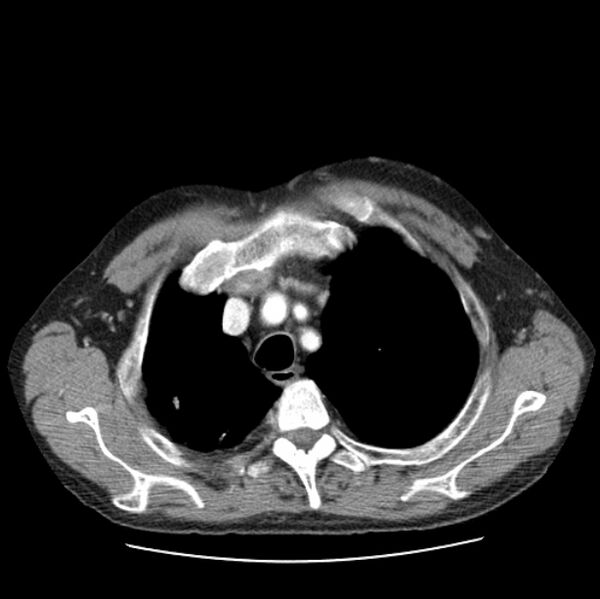 File:Autosomal dominant polycystic kidney disease (Radiopaedia 27851-28094 B 13).jpg