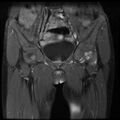 Avascular necrosis of the hip (Radiopaedia 29563-30067 I 4).jpg