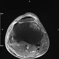 Avulsion fracture of the fibular head (Radiopaedia 74804-85808 Axial PD fat sat 27).jpg
